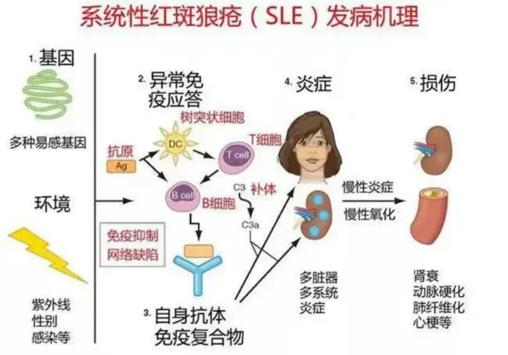 系统性红斑狼疮其实不可怕，科学管理是关键！